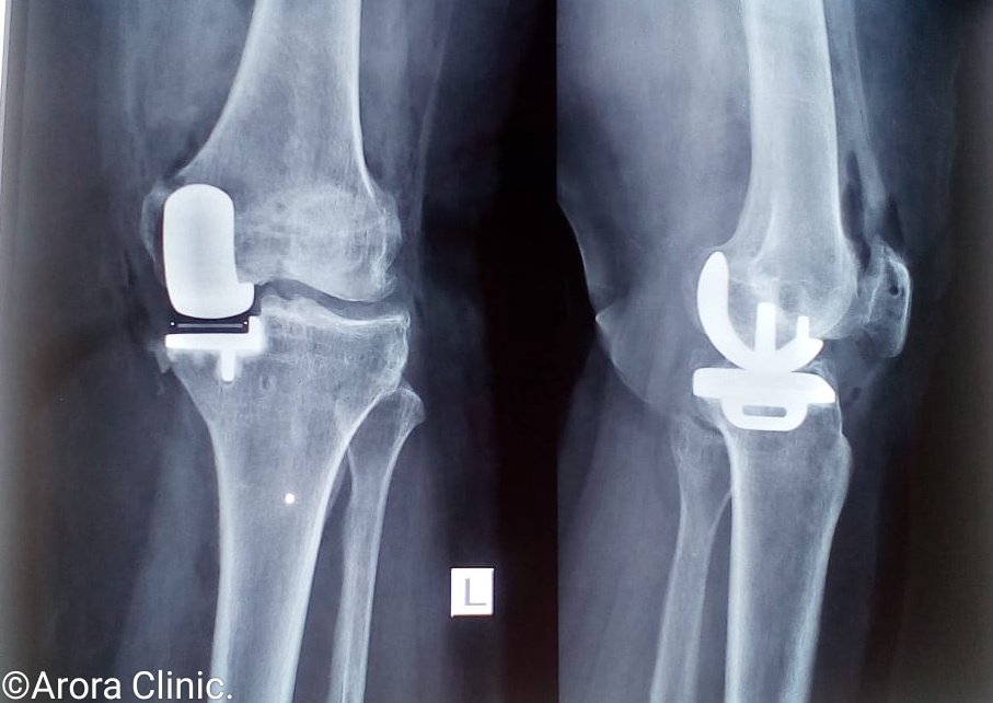 partial-knee-replacement-surgery-dr-bakul-arora-arora-clinic