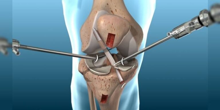 knee-arthroscopy-minimally-invasive-surgery-dr-bakul-arora