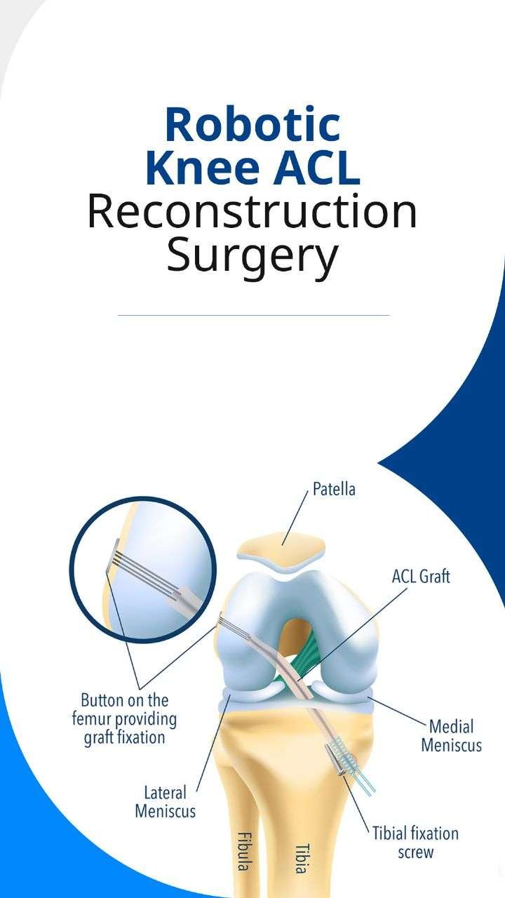 Robotic Knee ACL Reconstruction surgery