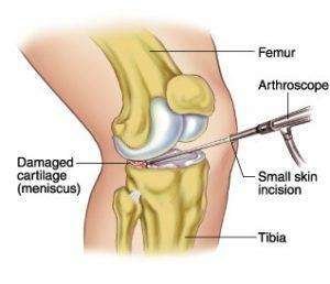 Why Is Meniscus Repair Surgery Needed