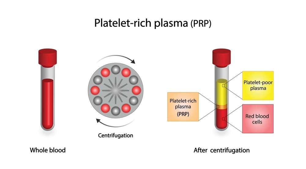 Platelet-rich plasma therapy for knee pain in Thane